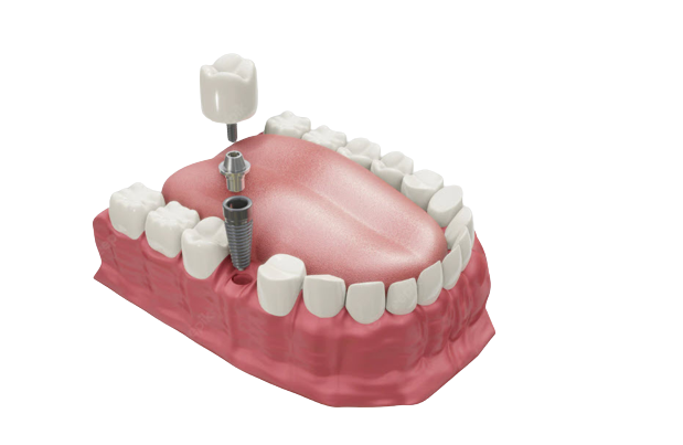 Установка имплантов Megagen в стоматологической клинике Альянс-Дент
