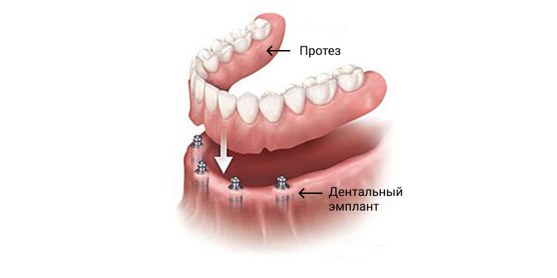 Проезирование зубов в стоматологической клинике Альянс-Дент